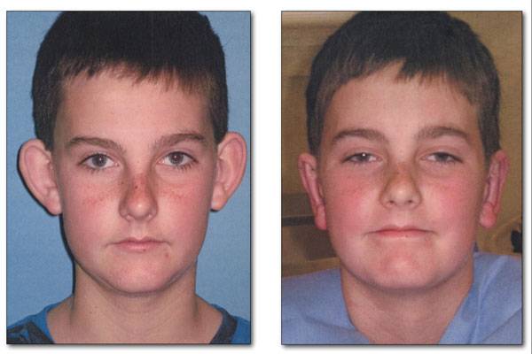 Лазерная отопластика (пластика ушей): отличия от классической отопластики, фото, отзывы, цена