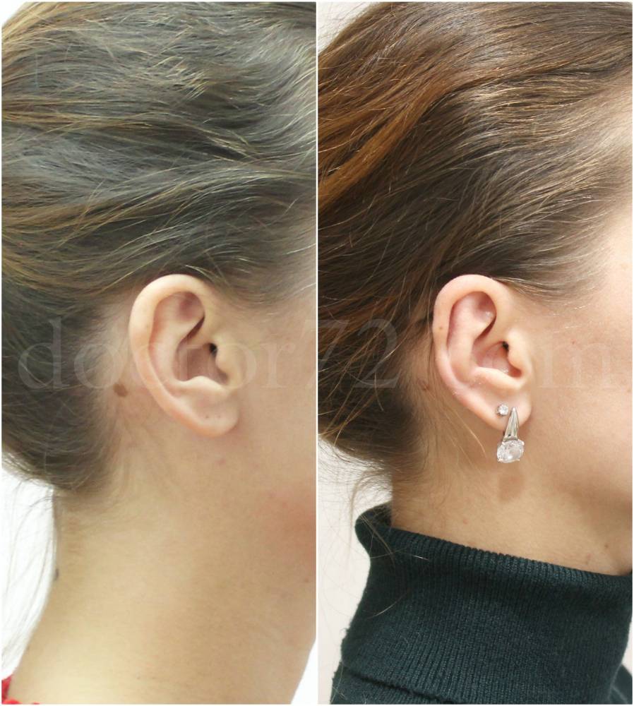 Пластика ушей (отопластика): виды, последствия, отзывы и цены