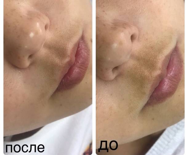 Отзывы с фотографиями до и после процедур пилинга rose de mer