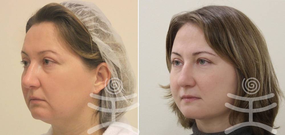 Стоит ли за лифтинг мендельсона отдавать так дорого?