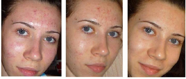 Дарсонваль при куперозе на лице