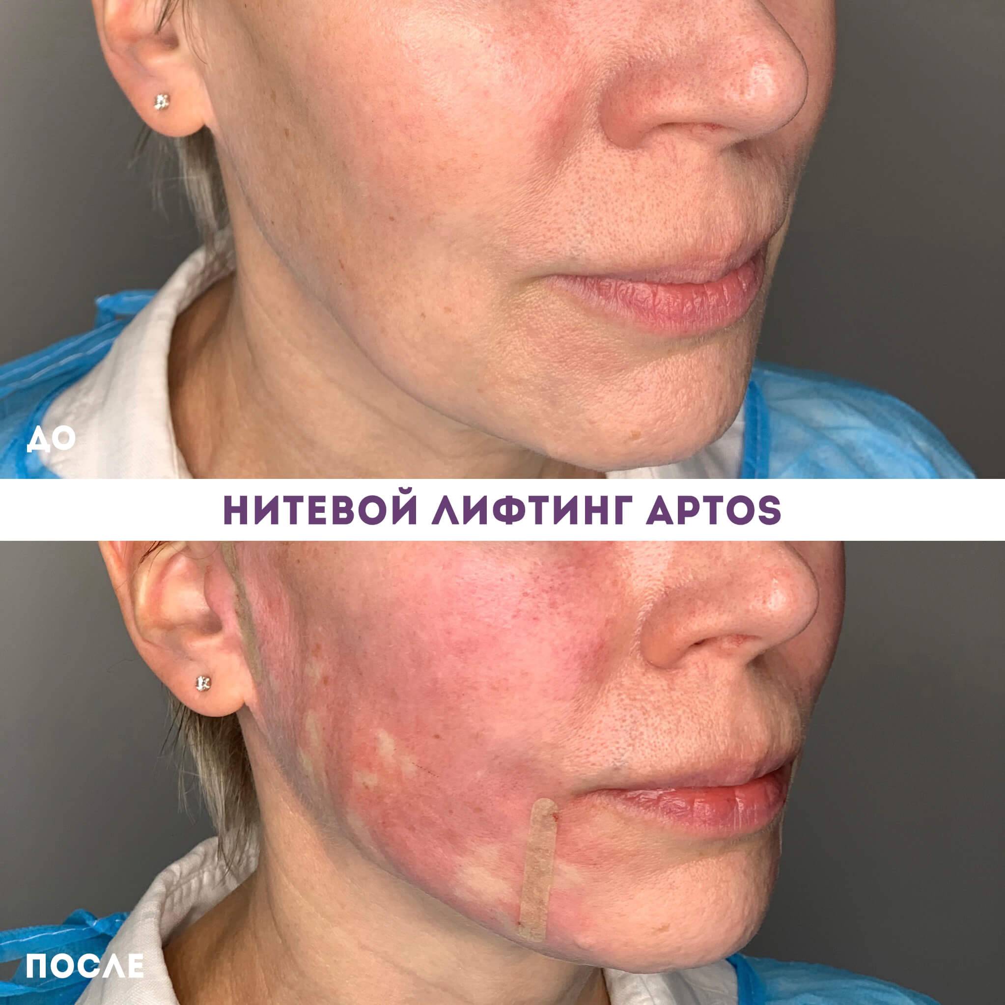 Подтяжка лица нитями: что это такое, цена на процедуру лифтинга, какова стоимость с рассасывающимся материалом, плюс и минусы проведения