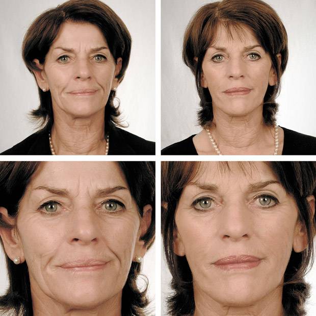 Мезотерапия: сколько длится эффект и как часто надо делать?