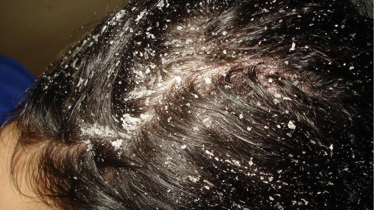 Особый уход для жирной кожи головы: домашние и профессиональные скрабы