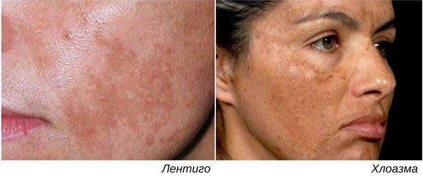 Пигментные пятна от загара: как избавиться, почему появляются