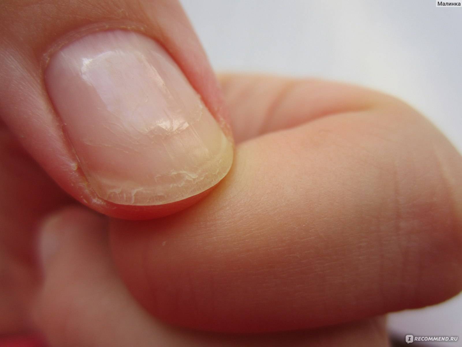 Почему ногти стали тоньше. Онихошизис ногтевой пластины.