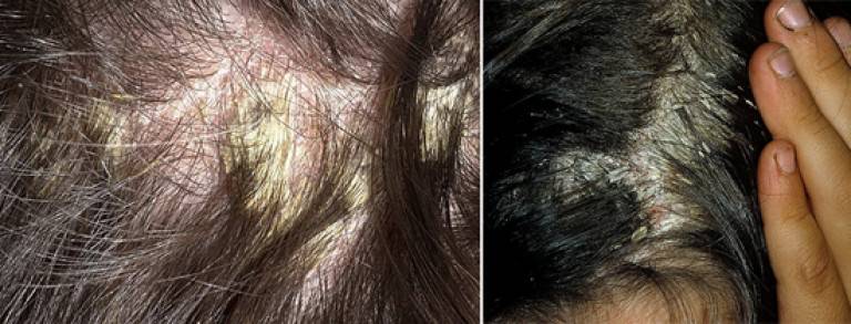 Секреты лечения жирной себореи (перхоти) кожи головы народными средствами: подробные рецепты и их применение