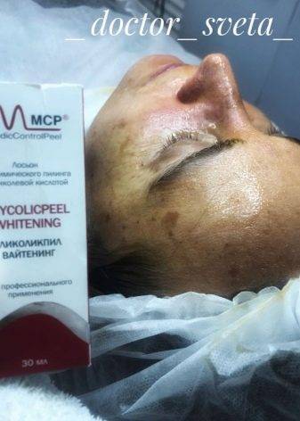 Всё что нужно знать о поверхностно-срединном пилинге аллюра эстетик