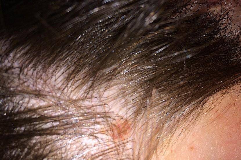 Красное пятно на затылке - врачебная тайна