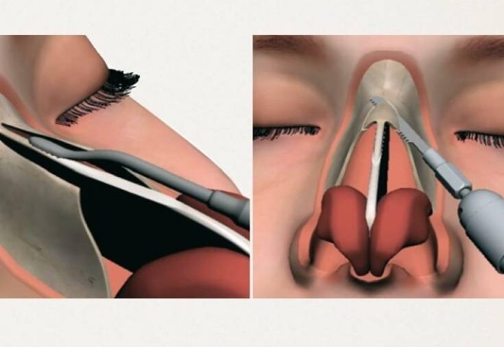 Исправление перегородки носа лазером: виды и отзывы об операции