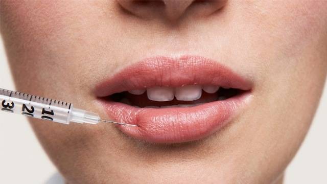 Что можно и нельзя делать после увеличения губ гиалуроновой кислотой