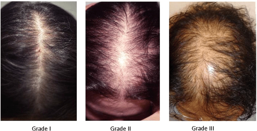 Выпадение волос у подростков девочек и мальчиков: что делать при потери локонов в переходном возрасте