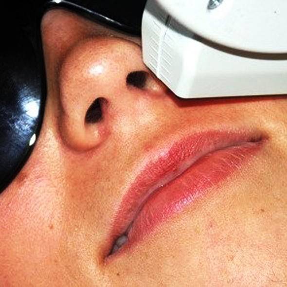 Что делать если после лазерной эпиляции на губе
