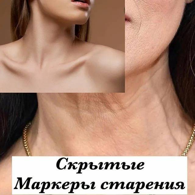 Кольца венеры – как убрать «непривлекательное украшение»