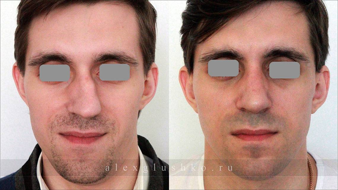 Исправление носовой перегородки лазером