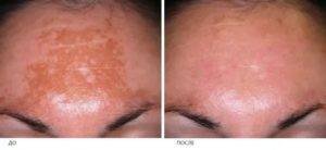 Избавление от пигментных пятен на лице народными средствами