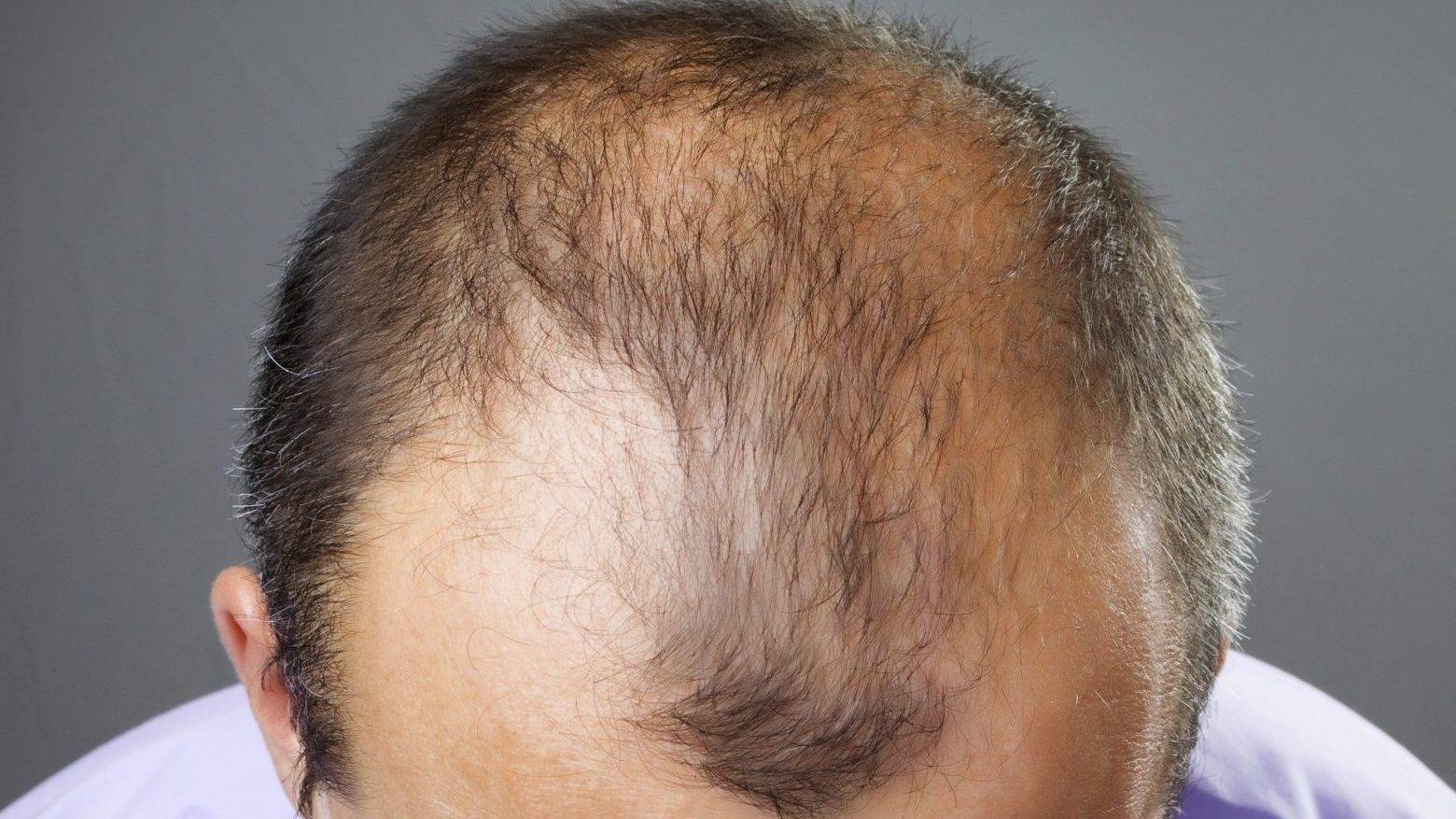 Почему выпадают волосы — причины и способы лечения