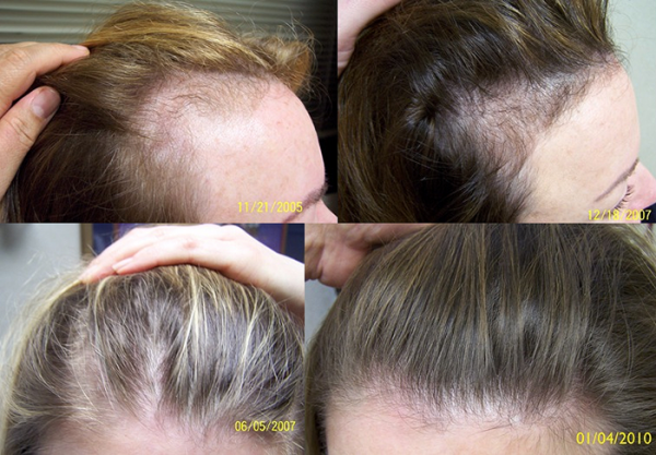 Выпадают волосы при беременности (16 фото): средства от выпадения волос во время беременности. что делать если сильно лезут волосы у беременных?