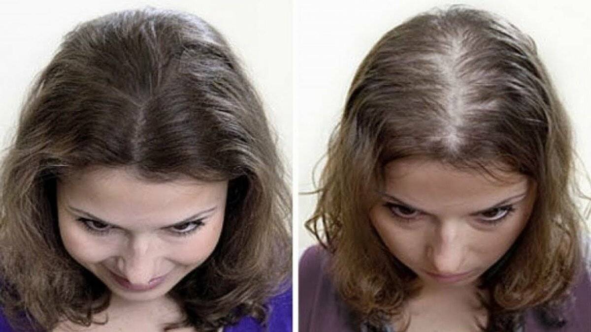 Выпадают волосы у ребенка в 3 года: причины, почему это бывает, и методы лечения