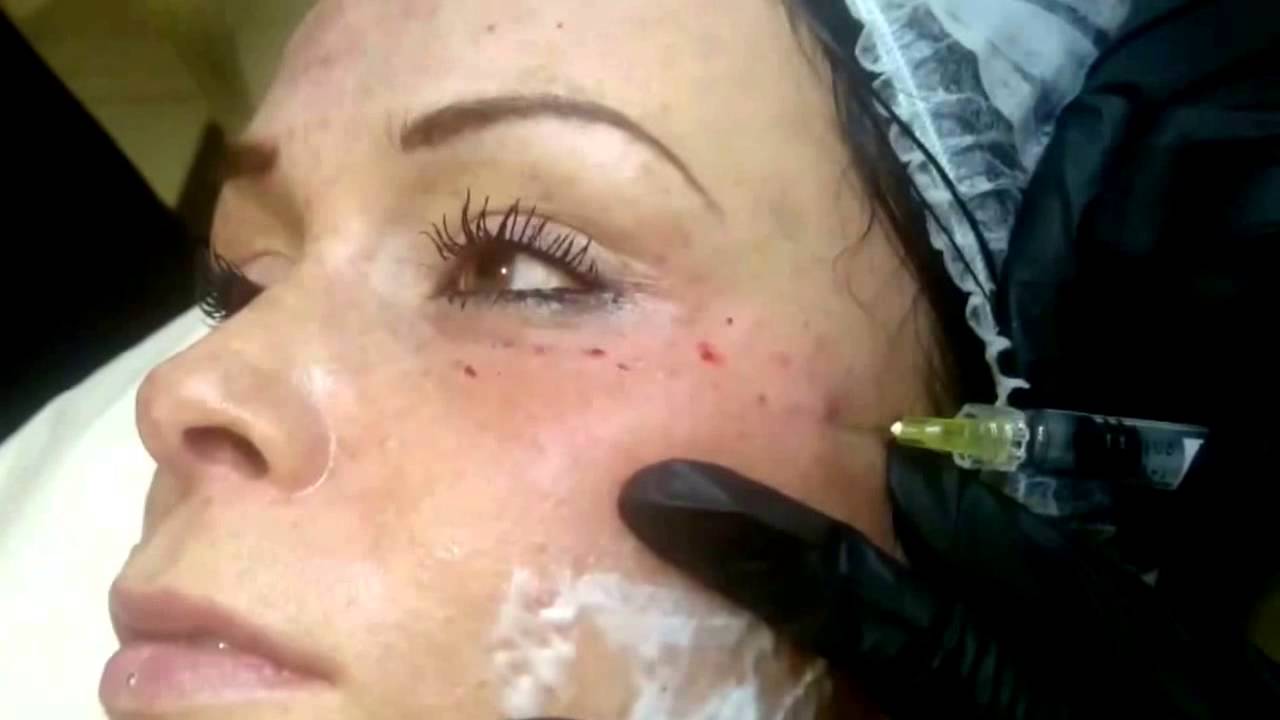 Viscoderm и viscoderm skinko - препараты для мезотерапии и биоревитализации