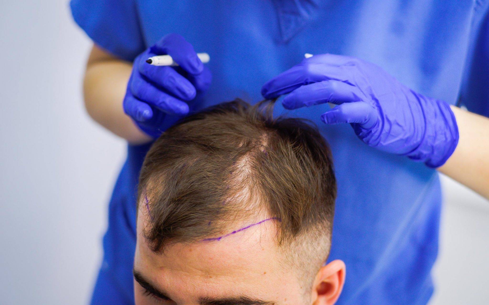 FUE представляет собой метод трансплантации волос, при котором происходит м...