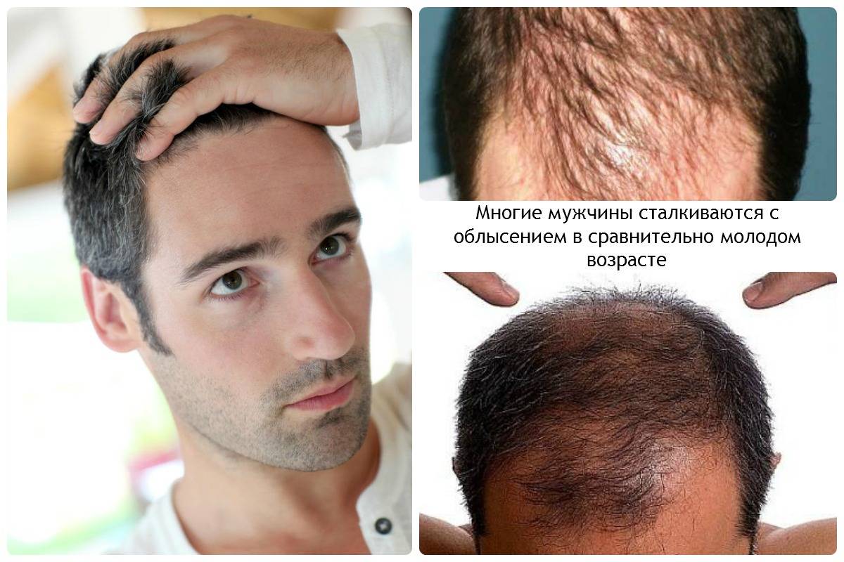 Выпадение волос у мужчин: причины и способы борьбы
