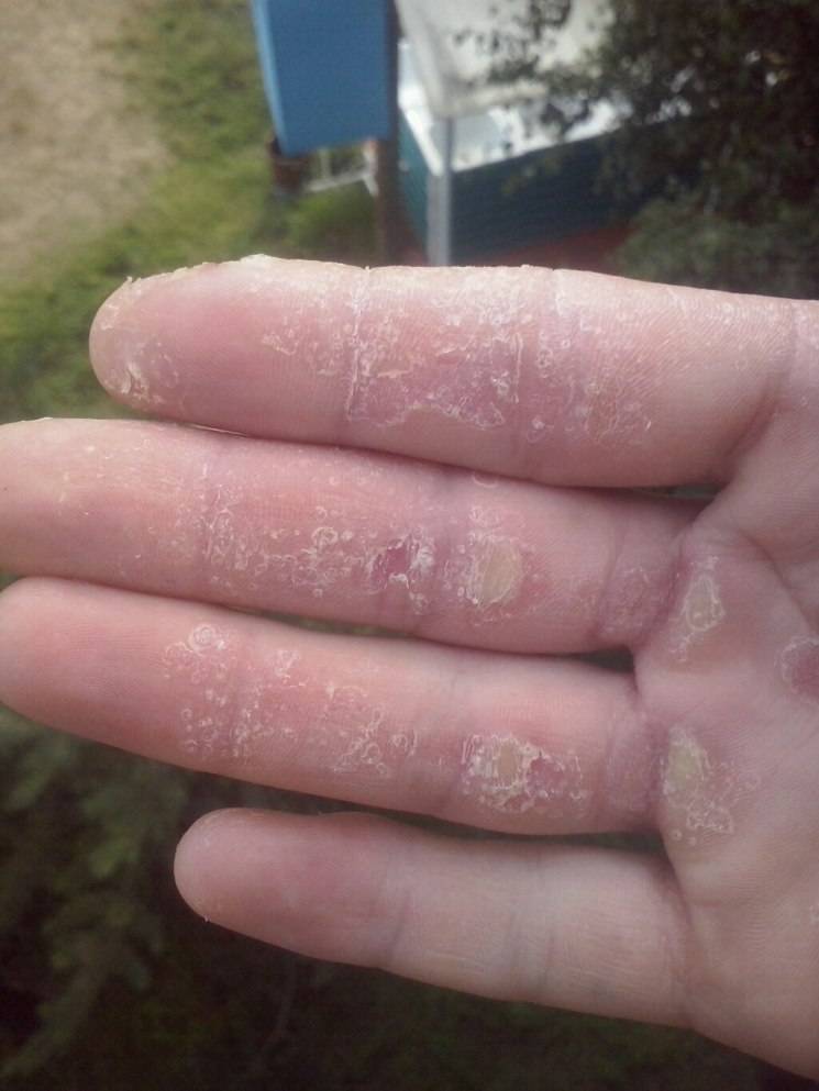 От чего шелушится кожа между пальцев рук thumbnail
