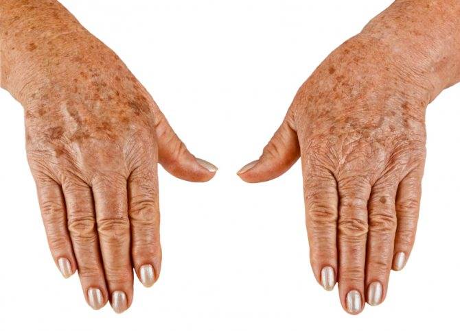 Пигментация на ногах причины лечение