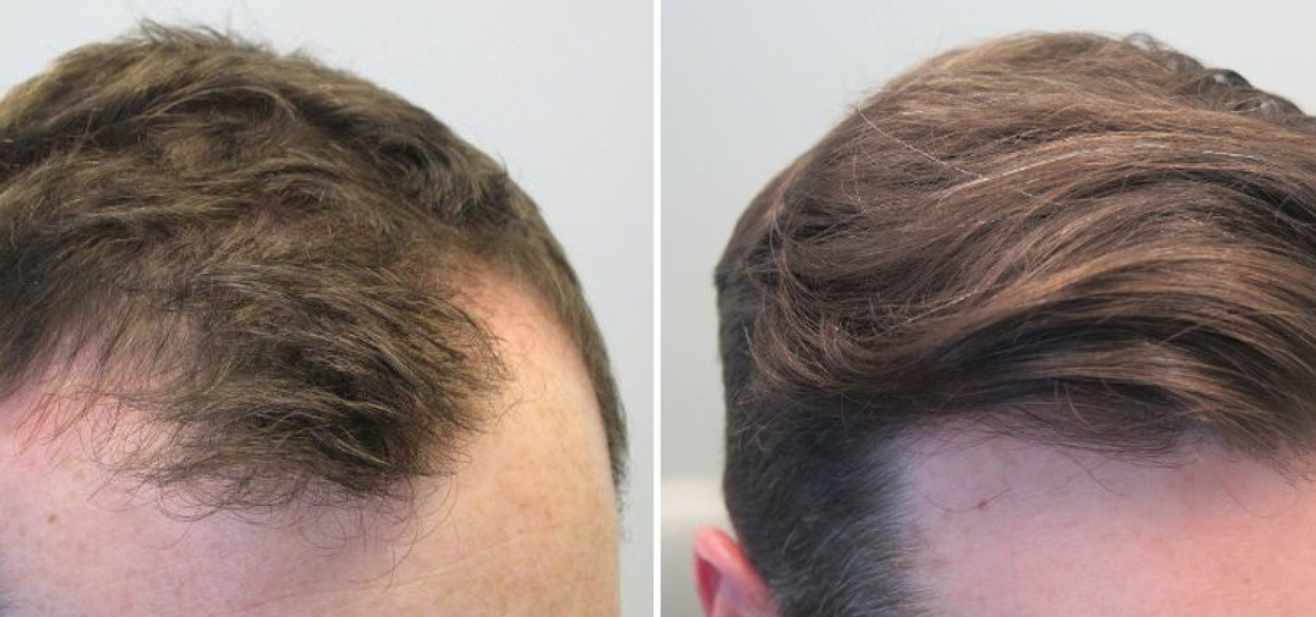 Отсутствие волос у мужчин