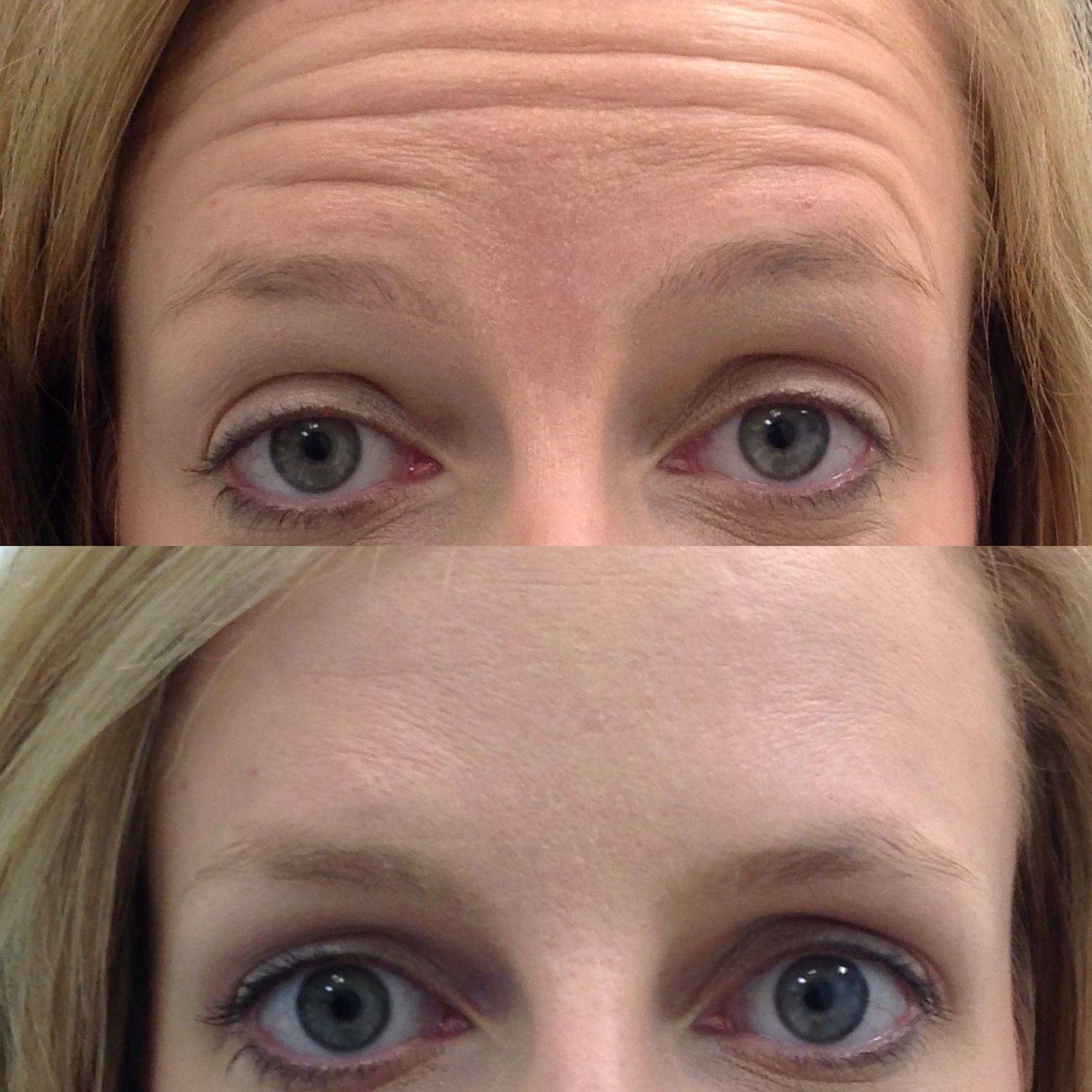 Ботокс в лоб: до и после, последствия, стоимость, противопоказания