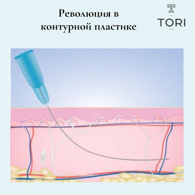 Канюля: можно ли избежать осложнений? | портал 1nep.ru