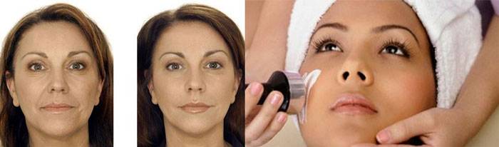 Ультразвуковой smas-лифтинг - показания к применению, результаты