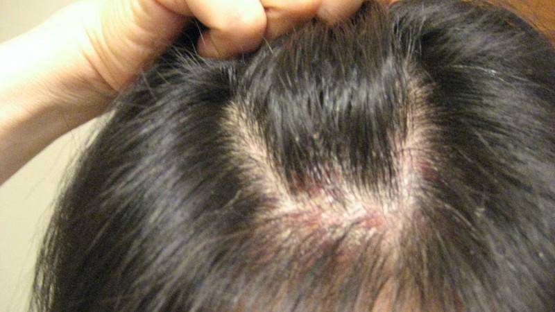 В чем причина появления красных пятен на голове под волосами, методы диагностики и лечения