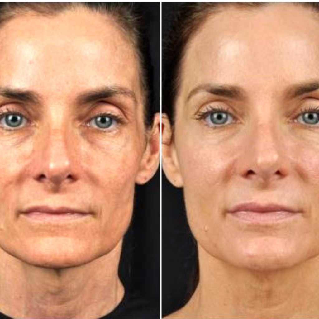 Липодистрофия что это. Лазерное омоложение лица фото до и после. Липодистрофия до и после. Возрастная липодистрофия лица.
