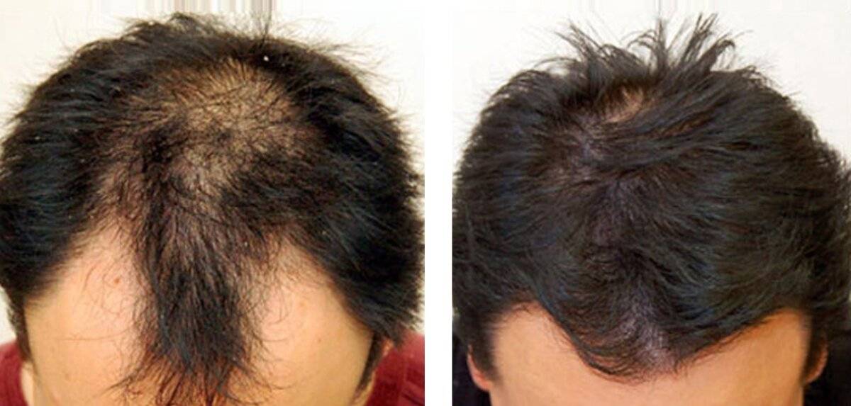 Что такое операция при выпадении волос