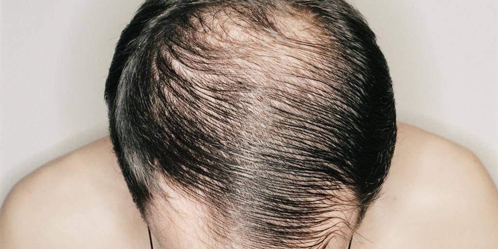 Почему выпадают волосы на голове: причины сильного выпадения волос у мужчин и женщин