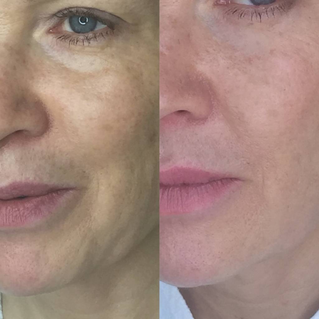 Биорепарация и биоревитализация отличия: чем отличаются и что лучше