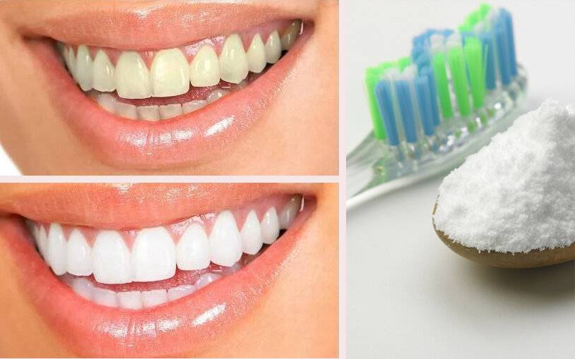 домашнее отбеливание зубов без вреда для эмали