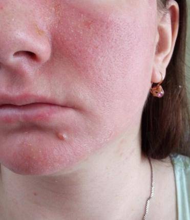 ᐉ ожог лица после депиляции. что нельзя делать при ожогах депиляцией. что нельзя делать при повреждении ➡ klass511.ru