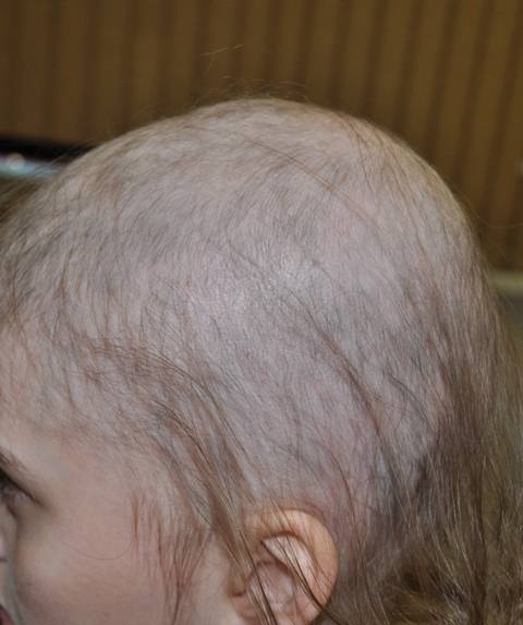 Выпадают волосы 4 месяц. Гнёздная алопеция у детей. Гнездная алопеция офиазис. Облысение затылка у детей. Редкие волосы у ребенка.