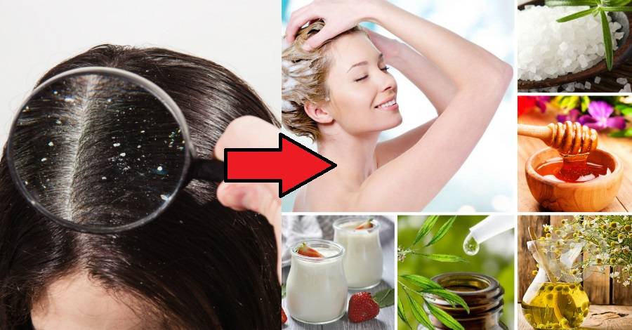 Как уменьшить жирность кожи головы: средства и масла для ухода, шампунь при себорее – что делать и как избавиться в домашних условиях