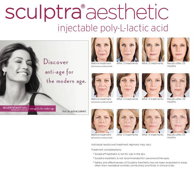 скульптра отзывы филлер
