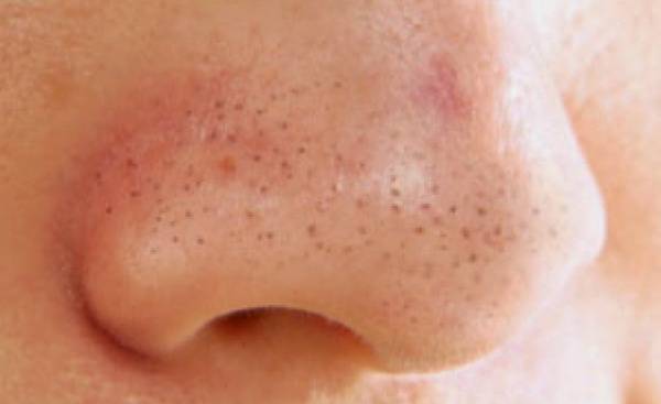 Как избавиться от прыщей на подбородке * вылечить угри в домашних условиях