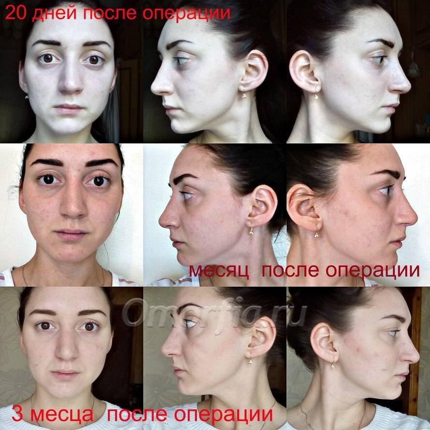 Выровнять перегородку носа поможет эндоскопическая септопластика | пластическая хирургия и косметология