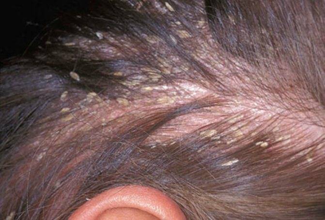 Причины и лечение зуда головы в домашних условиях, а также признаки заболеваний, связанных с жжением кожи у женщин и пожилых людей