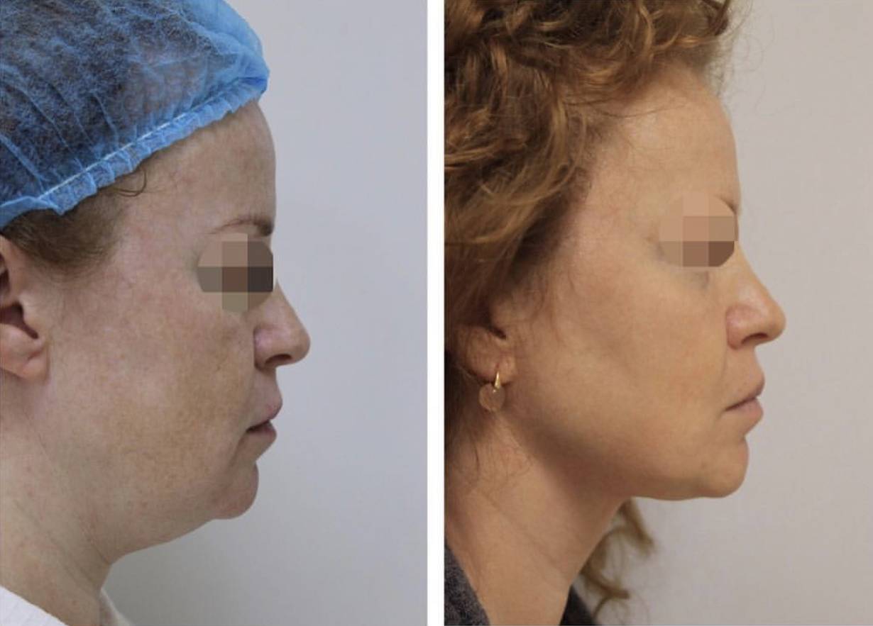 Лазерная липосакция живота: что это такое, фото до и после