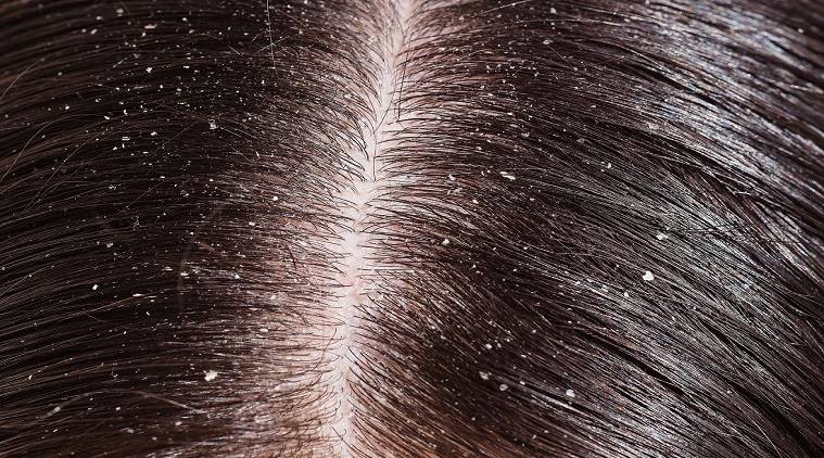 Действенные народные средства от перхоти и выпадения волос: как приготовить и использовать, частота применения и результат