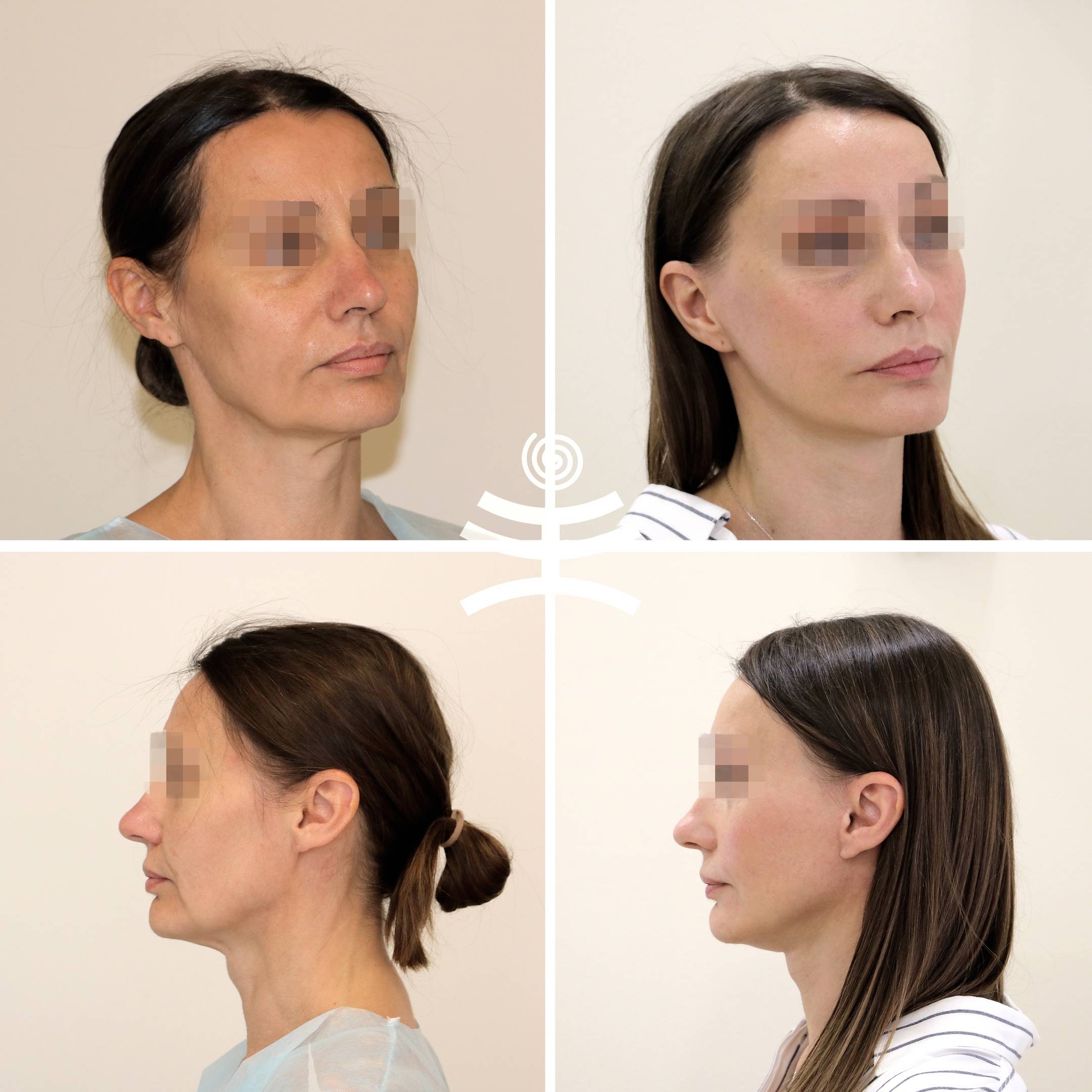 Как избавиться от брылей? лифтинг, smas-лифтинг, macs-lift.