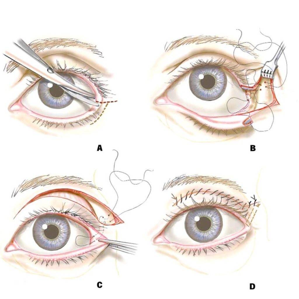 Какие есть операции на глаза. Кантопексия, кантопластика (подтяжка угла глаза). Операция латеральная кантопластика. Кантопексия миндалевидные глаза. Латеральная кантопластика глаз.