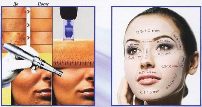 Техника выполнения мезотерапии: описание, противопоказания, ход выполнения, папульная, напаж и фракционная форма